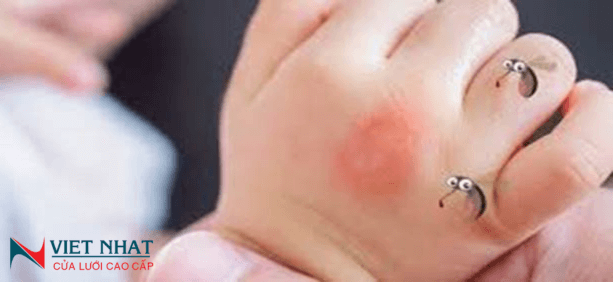 Cách xử lý muỗi đốt sưng to cứng cho trẻ nhanh và hiệu quả
