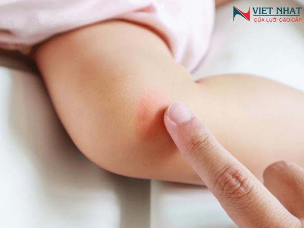 cách xử lý khi bé bị muỗi đốt